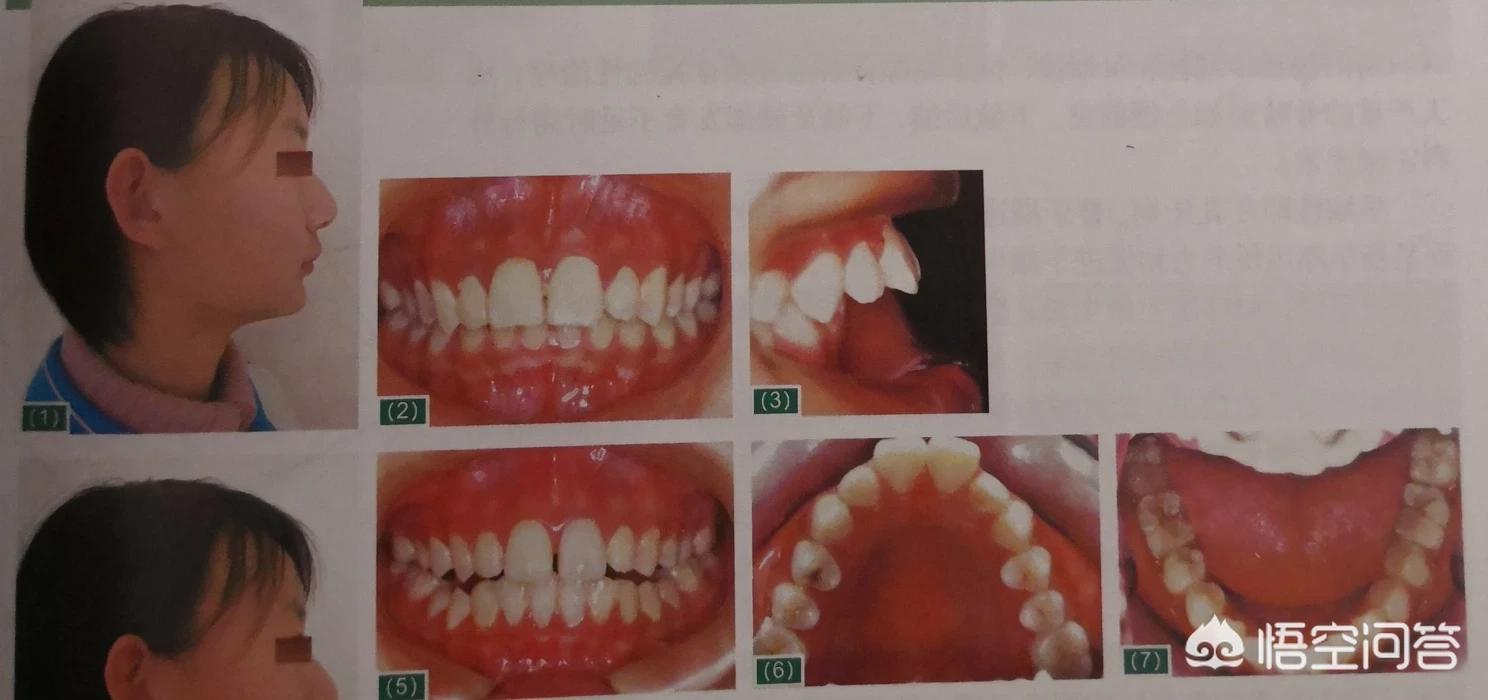 兔牙视频_兔牙视频旧版本安装